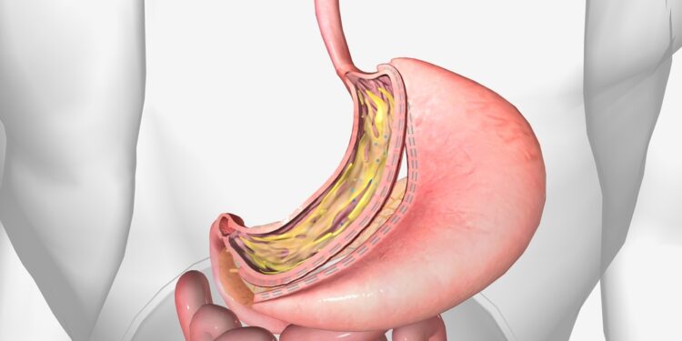 Svorio mažinimas ir rūgšties refliuksas