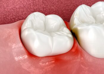 Protingųjų dantų tinimas