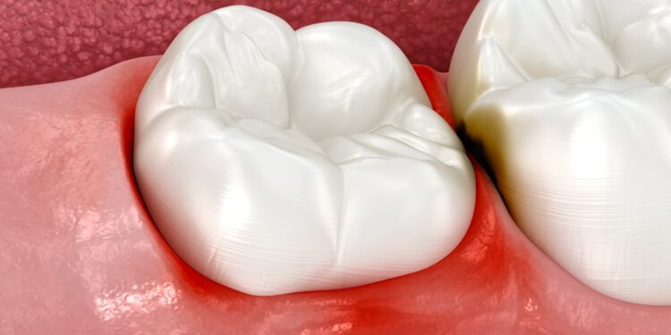 Protingųjų dantų tinimas