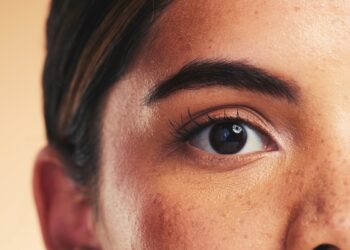 Melasmos gydymas namų priemonėmis