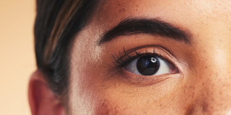 Melasmos gydymas namų priemonėmis