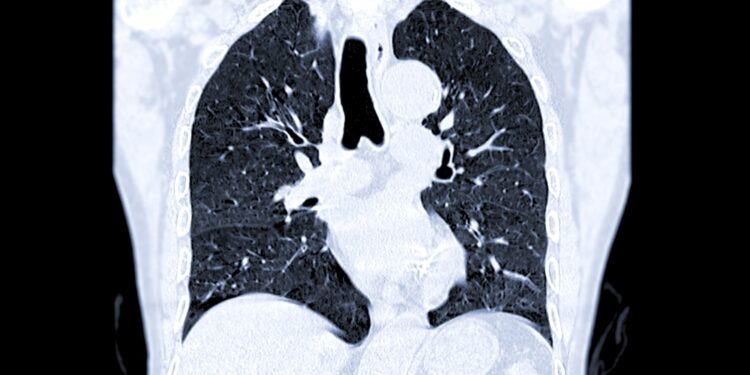 Ar nėštumo metu gali ištikti plaučių embolija?