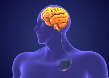 Klausimas apie klajoklio nervo stimuliacijos (VNS) taikymą depresijai gydyti: ar tai rekomenduojama?