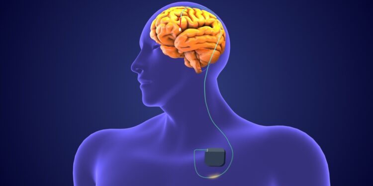 Klausimas apie klajoklio nervo stimuliacijos (VNS) taikymą depresijai gydyti: ar tai rekomenduojama?