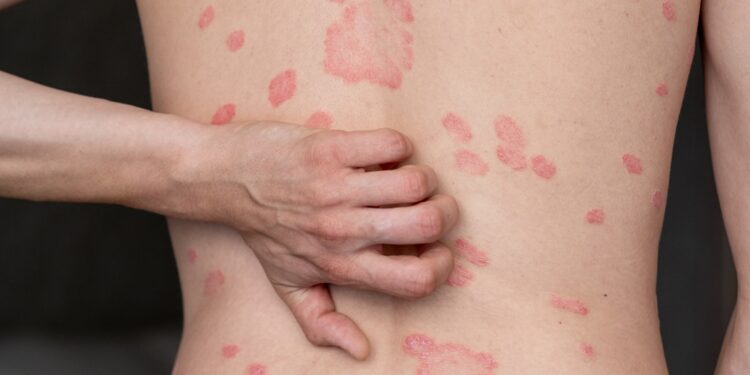 Ką daryti, kai žmonės tavęs (ar tavo psoriazės) nepalaiko