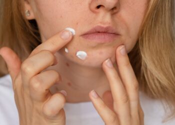 Kaip atsikratyti uždegiminio aknės bėrimo