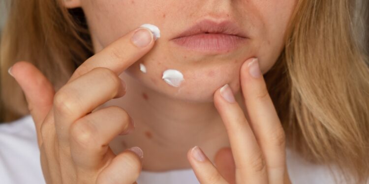 Kaip atsikratyti uždegiminio aknės bėrimo