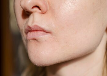 Apie lūpas atsirandantis cianozė: ar tai pavojinga?