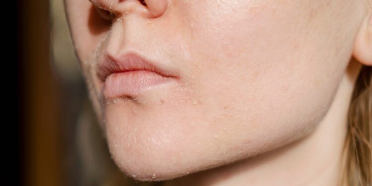 Apie lūpas atsirandantis cianozė: ar tai pavojinga?