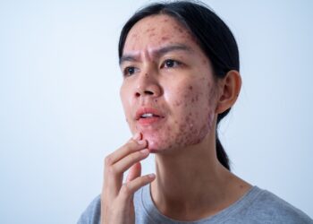 Ar melanomos niežti?