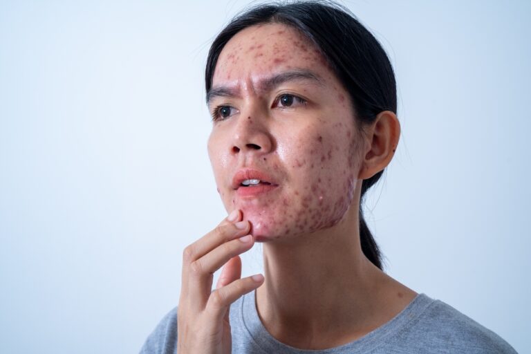 Ar melanomos niežti?