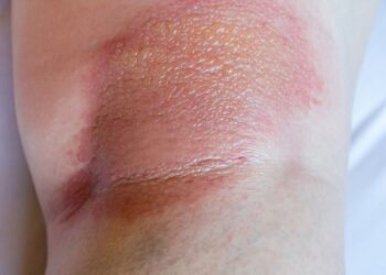 Spuogas ant kelio: priežastys ir gydymas