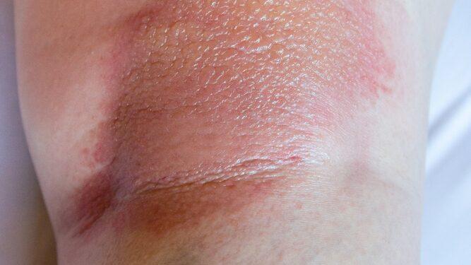 Spuogas ant kelio: priežastys ir gydymas