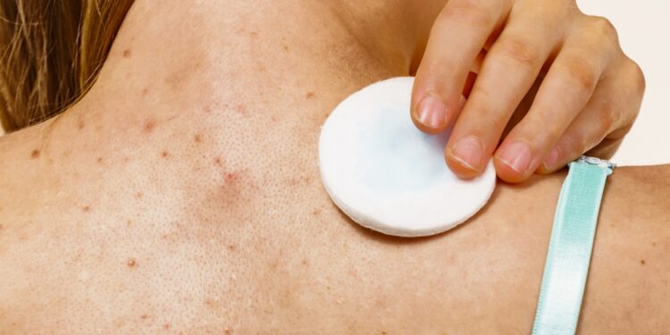 Randinė kaklinės srities aknė