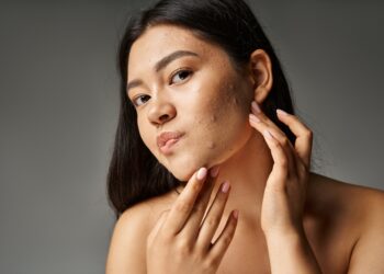 Spuogai prie plaukų linijos