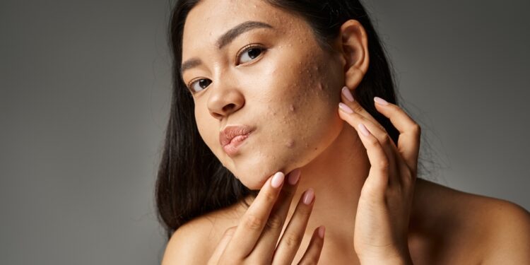 Spuogai prie plaukų linijos