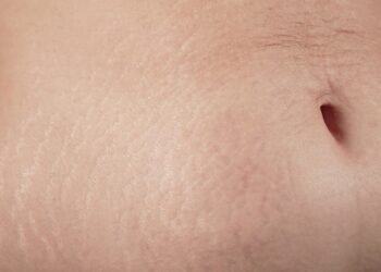 Ar strijos išnyksta?