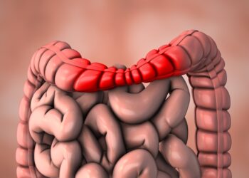 Ar dirgliosios žarnos sindromas (DŽS) yra lėtinė liga?