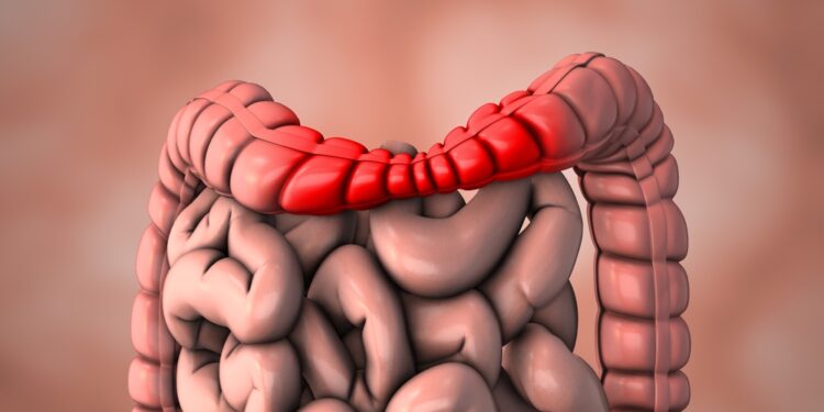 Ar dirgliosios žarnos sindromas (DŽS) yra lėtinė liga?