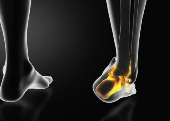 Kurį pasirinkti: čiurnos sąnario suaugdinimą ar keitimą?