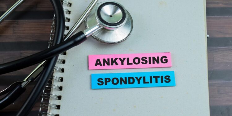 29 dalykai, kuriuos supras tik sergantieji ankiloziniu spondilitu