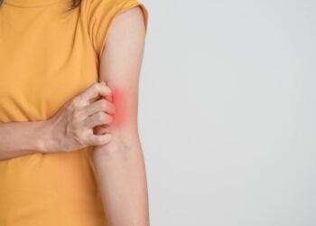 Ar vilkligės bėrimas niežti?