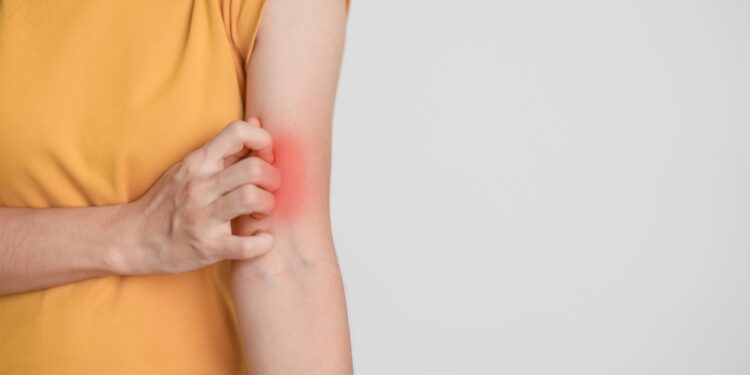 Ar vilkligės bėrimas niežti?