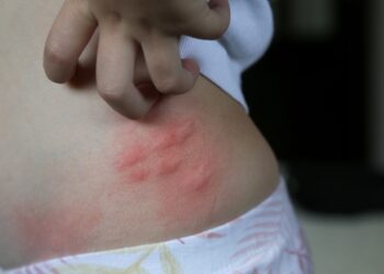 Vilko voro įkandimas