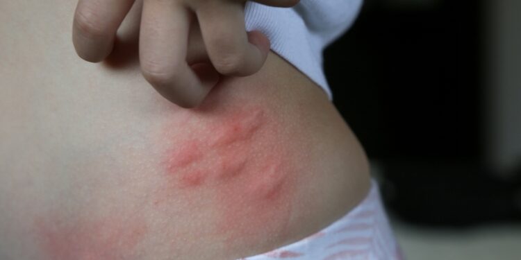 Vilko voro įkandimas