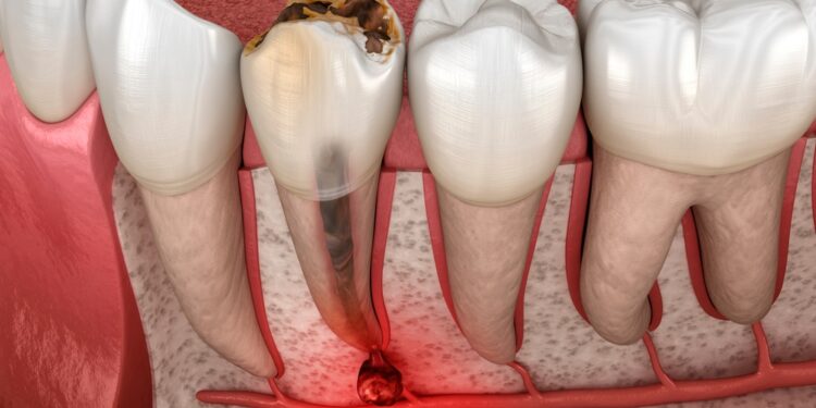 Danties-užuomazginė cista