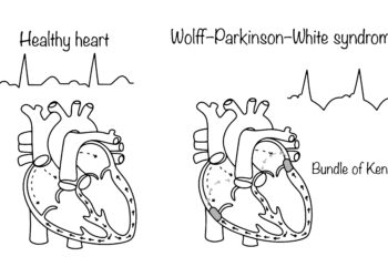 Volfo–Parkinsono–Vaito sindromas