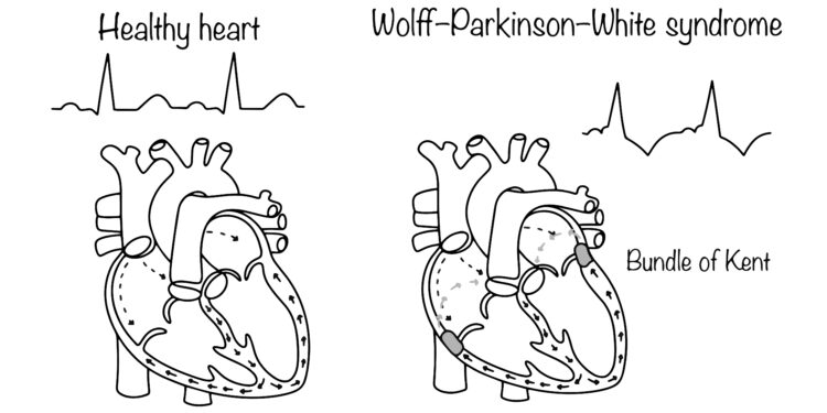 Volfo–Parkinsono–Vaito sindromas