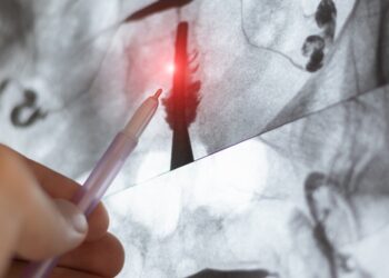 Dubens MRT dėl endometriozės: kam jis atliekamas?