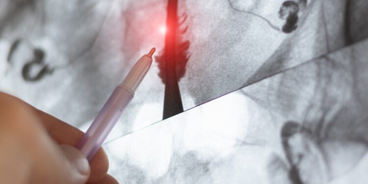 Dubens MRT dėl endometriozės: kam jis atliekamas?