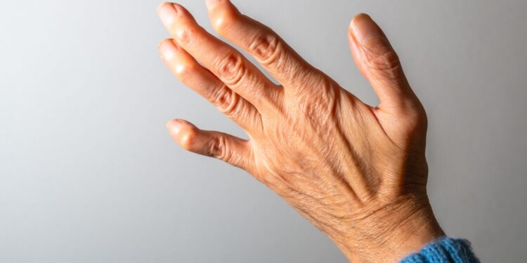 Boutonnière deformacijos gydymas