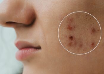 4 natūralios priemonės aknės randams mažinti