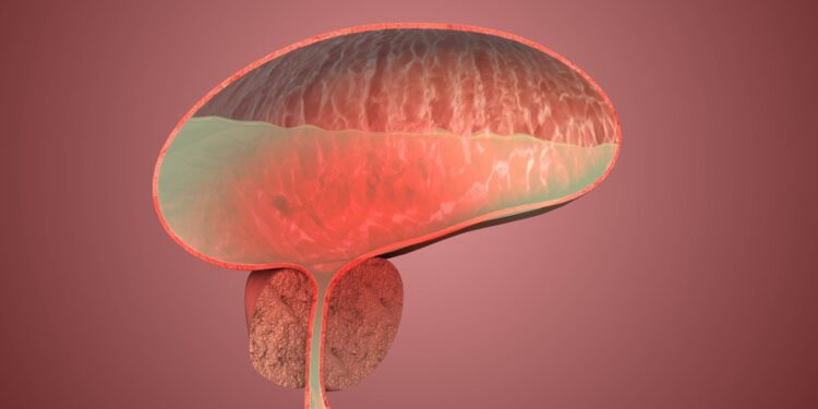 Gerybinis šlapimo pūslės navikas