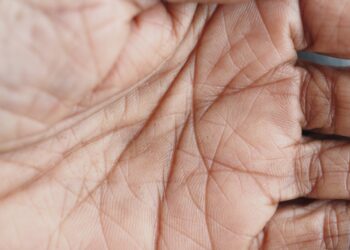 Vienguba delno raukšlė