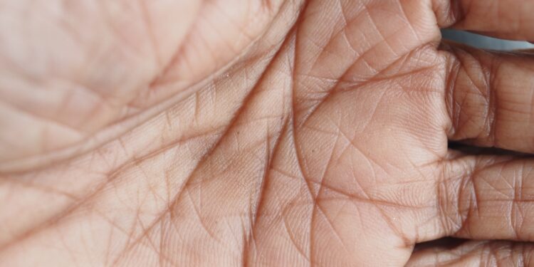 Vienguba delno raukšlė