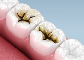 Ar tarp jūsų dantų yra ėduonies pažeista vieta?