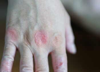 Alergijos vaistams simptomai