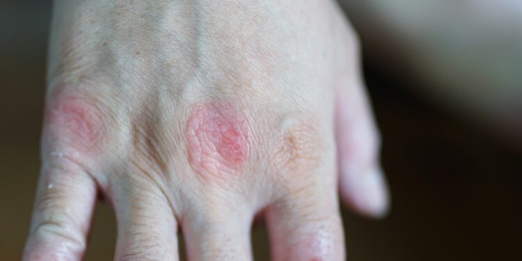 Alergijos vaistams simptomai