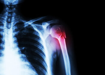 Kaip veikia Nurtec ODT