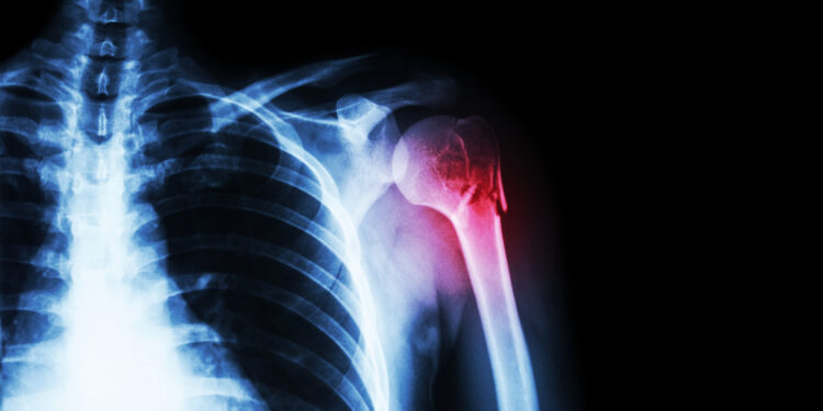 Kaip veikia Nurtec ODT