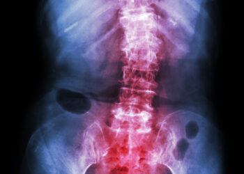 Kasdienio gyvenimo valdymas sergant ankiloziniu spondilitu