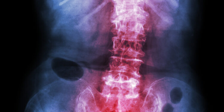 Kasdienio gyvenimo valdymas sergant ankiloziniu spondilitu