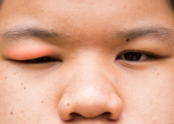 Patinusių akių vokų priežastys