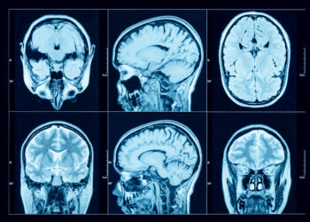 Ar žmonės, sergantys Kleine-Levino sindromu, valgo?