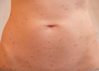 Ar pitirijazė rožė yra užkrečiama?