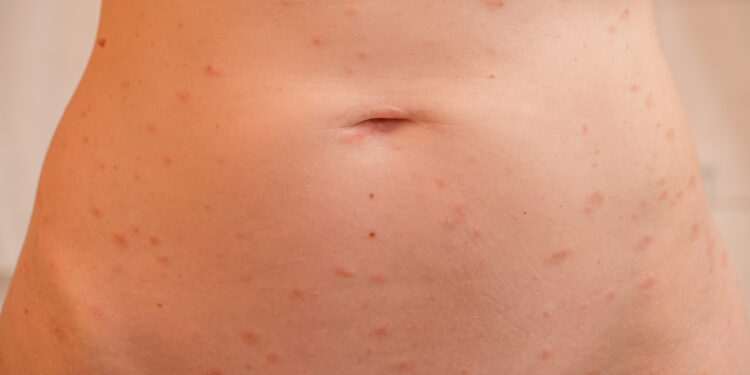 Ar pitirijazė rožė yra užkrečiama?